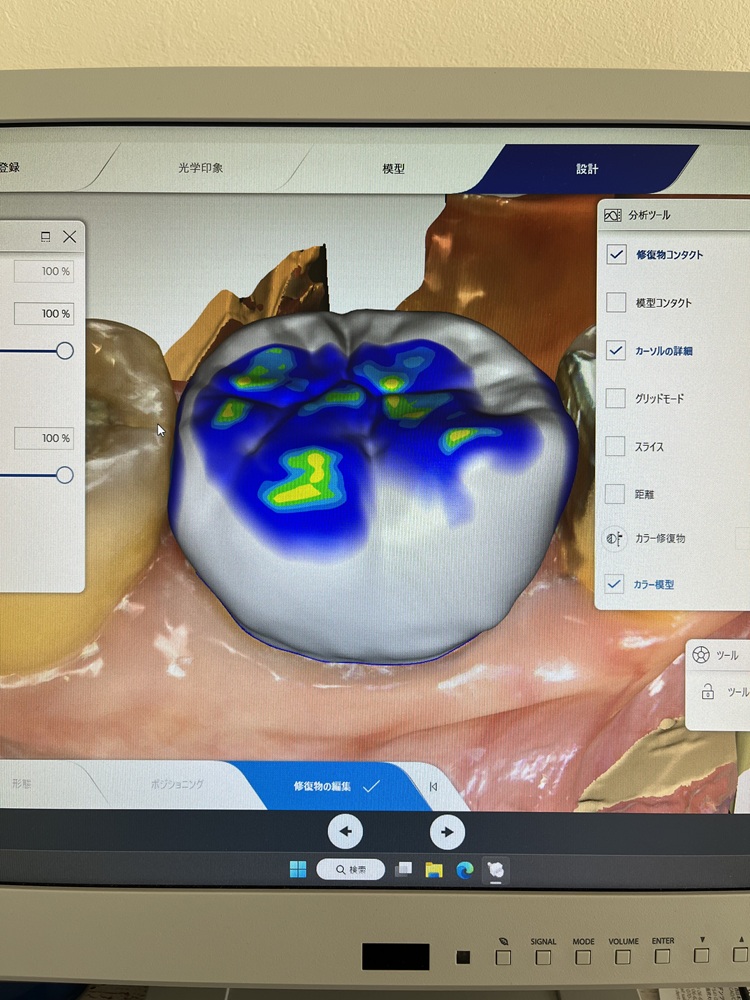 口腔内スキャナー